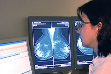 De sis setmanes a cinc dies de tractament per a càncers de mama poc avançats