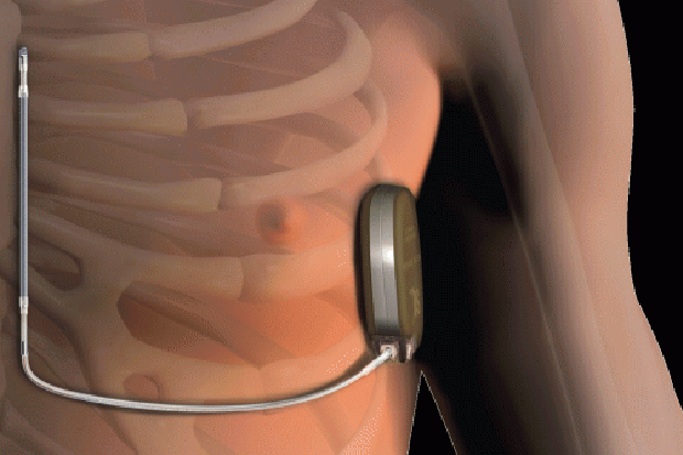 El Clínic implanta el primer desfibril·lador sense elèctrodes intracardíacs de Catalunya | cardiologia, Hospital Clínic, medicina