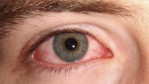 Els oftalmòlegs confirmen que el coronavirus pot causar conjuntivitis