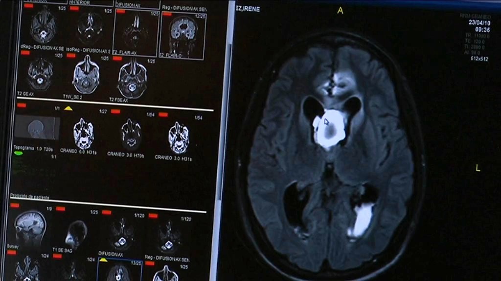 Imatge de la radiografia d'un cervell