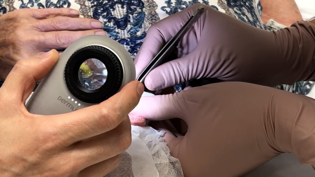 Dermatòlegs alerten sobre el càncer de pell: "No hauríem de continuar bronzejats a la tardor" | calor, càncer, canvi climàtic, estiu, Hospital del Mar