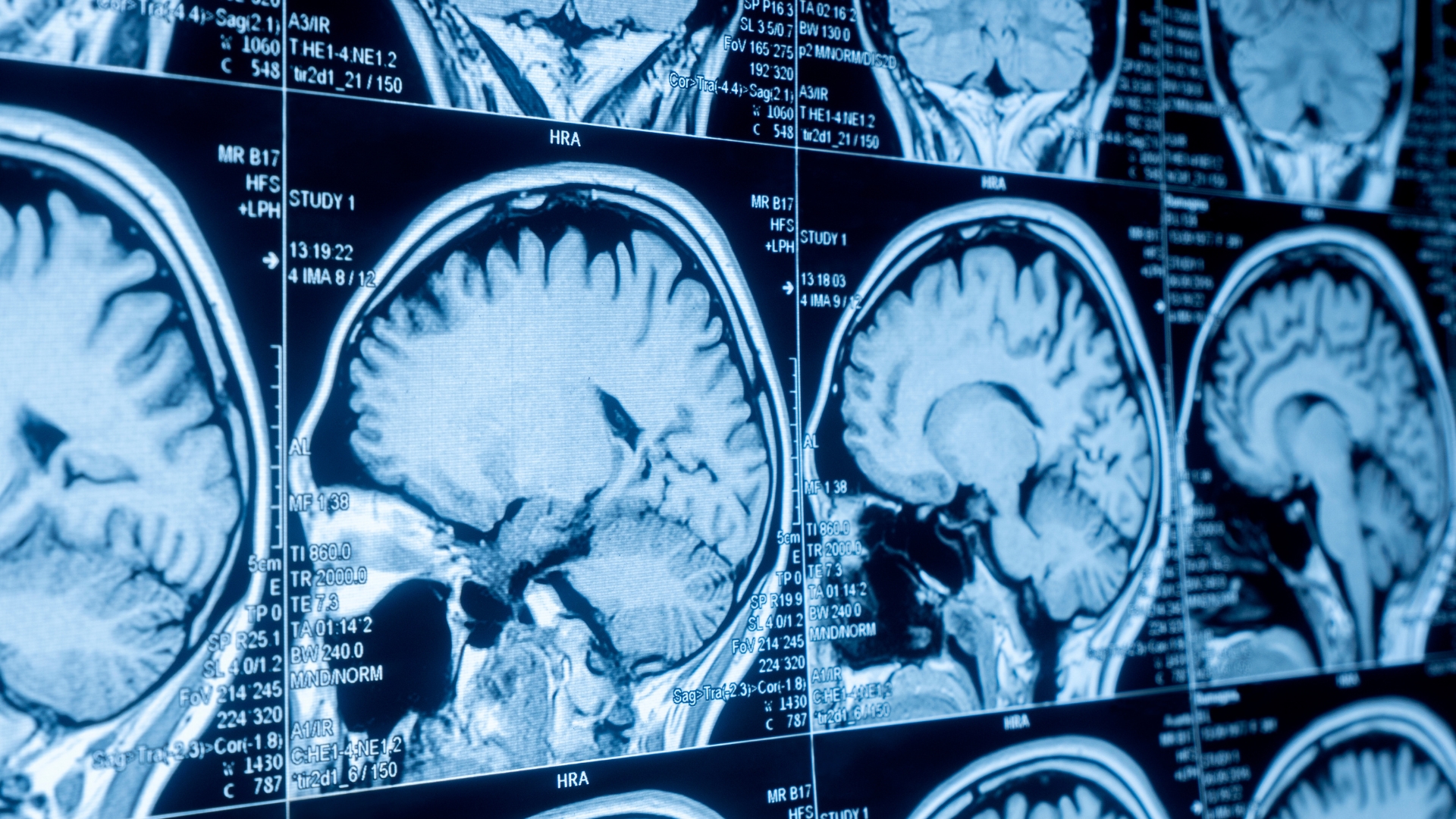 pegat tumor cerebral