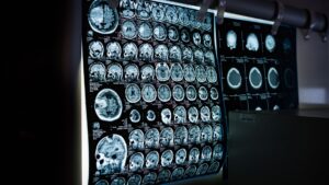 Troben marcadors cerebrals del trastorn límit de la personalitat durant l’adolescència